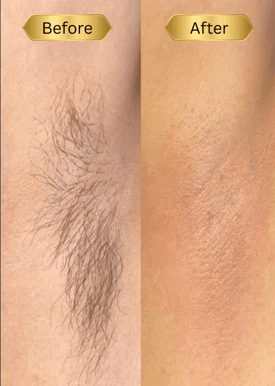 Rezultate epilare cu zahăr la axile în Chișinău. Eliminarea umbrei lăsate de lamă și a firelor groase pentru o piele luminoasă.