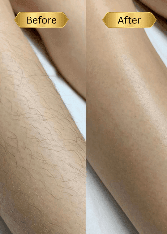 Rezultat înainte și după epilarea cu zahăr pe picioare în Chișinău. Piele fină, fără iritații și fără fire sub piele.