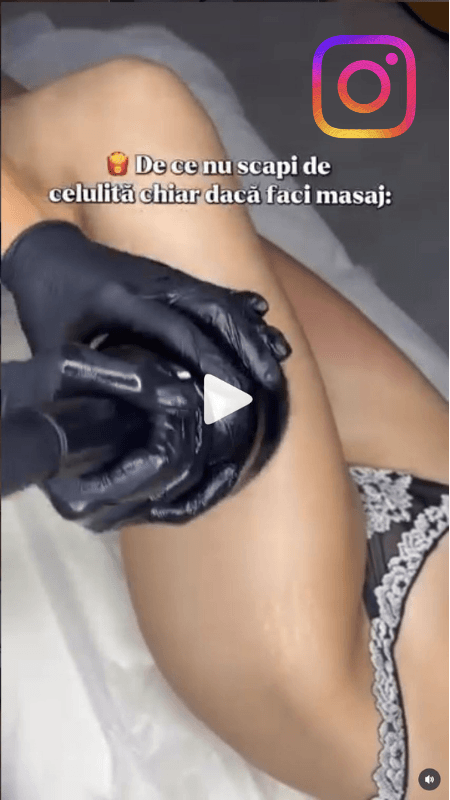 Procedura de eliminare a celulitei pe picioare folosind tehnologia de vibromasaj în Chișinău.