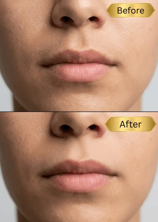 Professional facial sugaring before and after result for sensitive skin in Chisinau studio